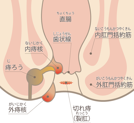 最高のコレクション いぼ 痔 写真 画像 200758いぼ 痔 画像 写真